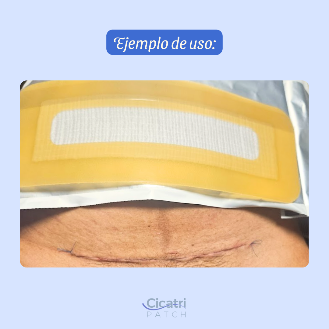 CicatriPatch - Parche de Silicón y Plata Iónica para Cicatrización Postoperatoria - Imagen 5