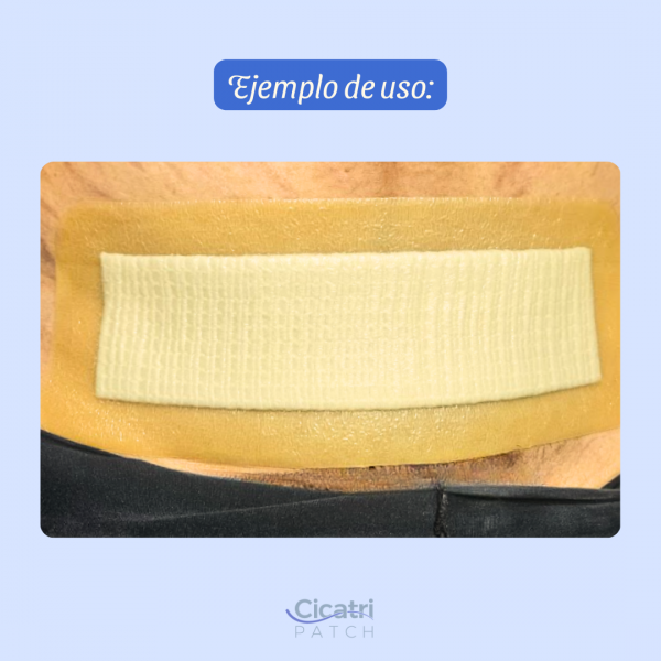 CicatriPatch - Parche de Silicón y Plata Iónica para Cicatrización Postoperatoria - Imagen 6